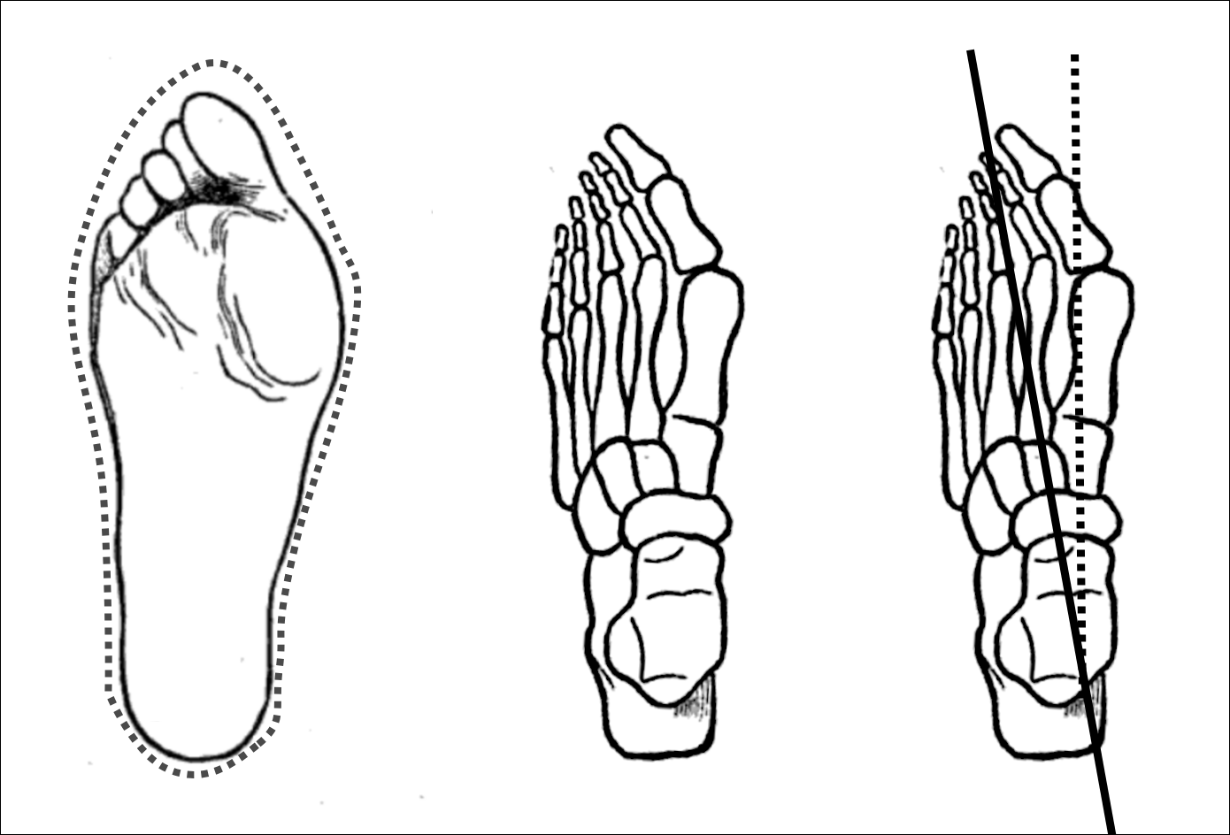 Toe Spacers - MT Performance